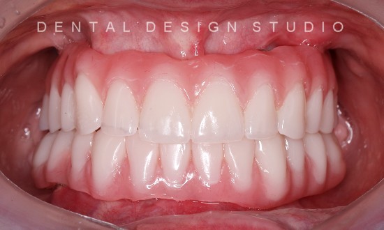 Zygomatic Dental implants in cancun